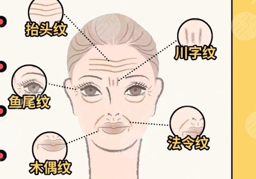 7d聚拉提臉部多少錢(qián)做一次？