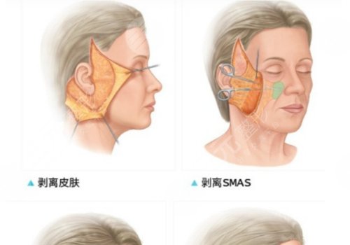 上海伊萊美拉皮多少錢?