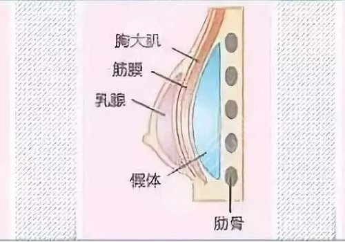傲諾拉隆胸假體多少錢？