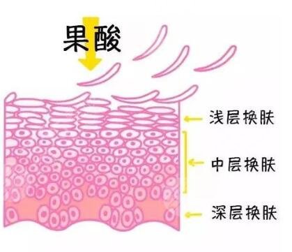 果酸換膚的副作用多久會(huì)顯現(xiàn)出來?
