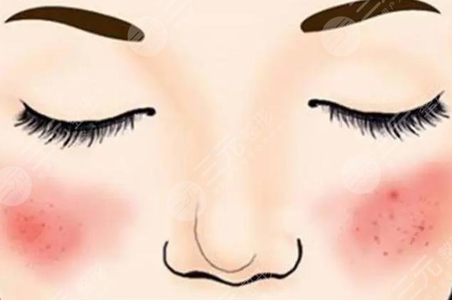 激光去紅血絲會(huì)反彈嗎