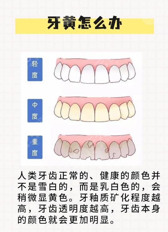 牙齒發(fā)黃變白的方法有哪些