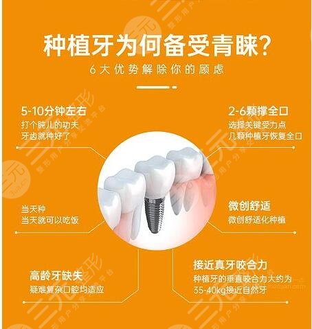 種植牙的使用壽命有多久?