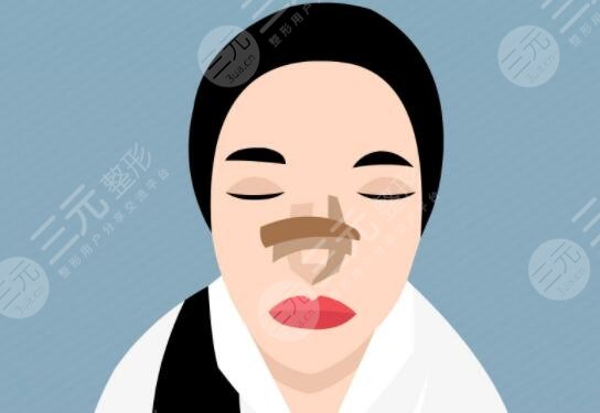 自體軟骨隆鼻好嗎有效果嗎？材料優(yōu)勢(shì)/價(jià)格多少錢/注意事項(xiàng)