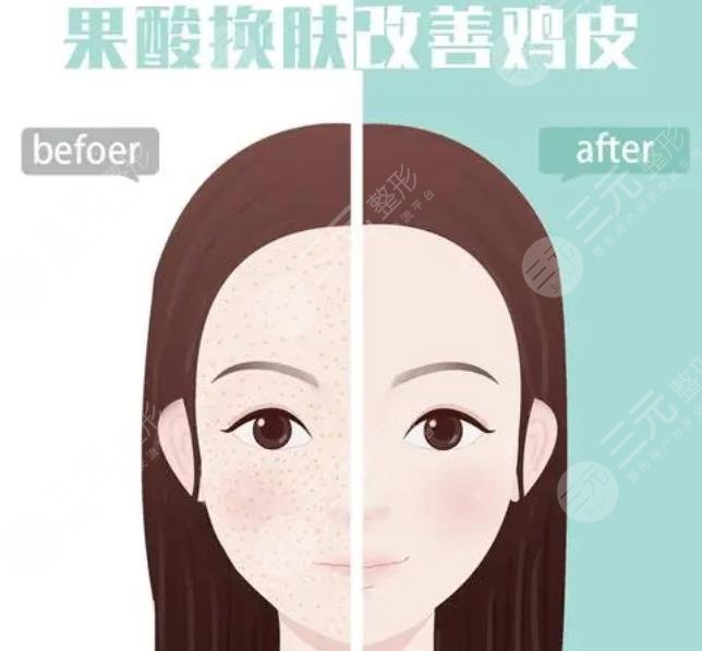 醫(yī)院果酸多少錢(qián)一次