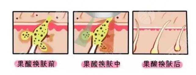 醫(yī)院果酸多少錢(qián)一次