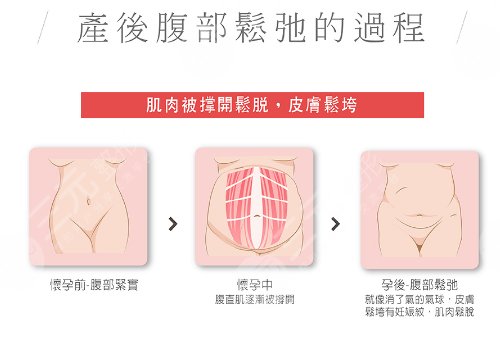 腹部拉皮手術(shù)費(fèi)多少錢？