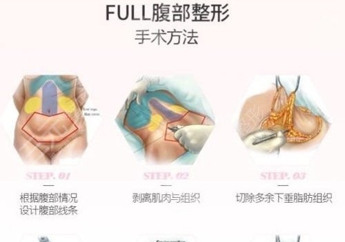 腹部拉皮手術(shù)費(fèi)多少錢？