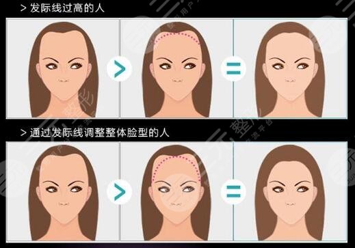 紋發(fā)際線