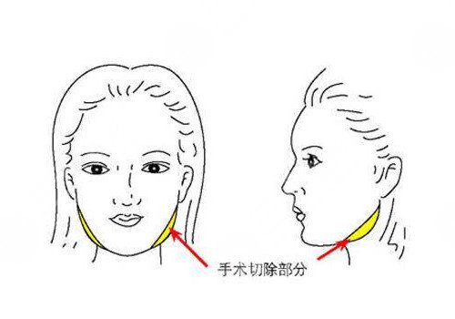 北京聯(lián)合麗格磨骨怎么樣?