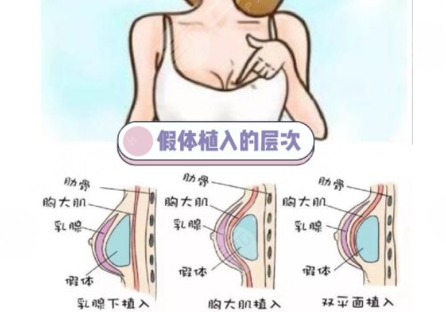 毛面假體和光面假體哪個好?