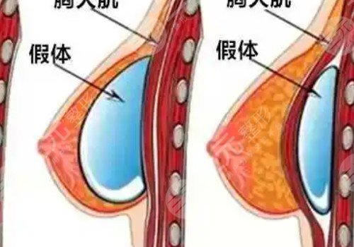 光面假體和毛面假體的優(yōu)缺點