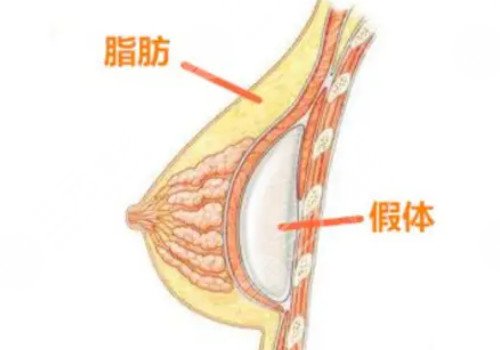 光面假體和毛面假體的優(yōu)缺點
