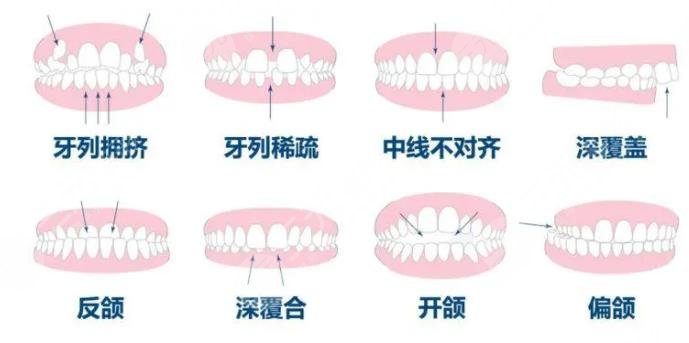 牙齒矯正