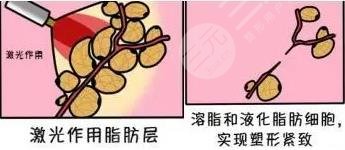 光纖溶脂