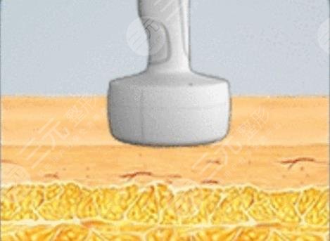 光纖溶脂