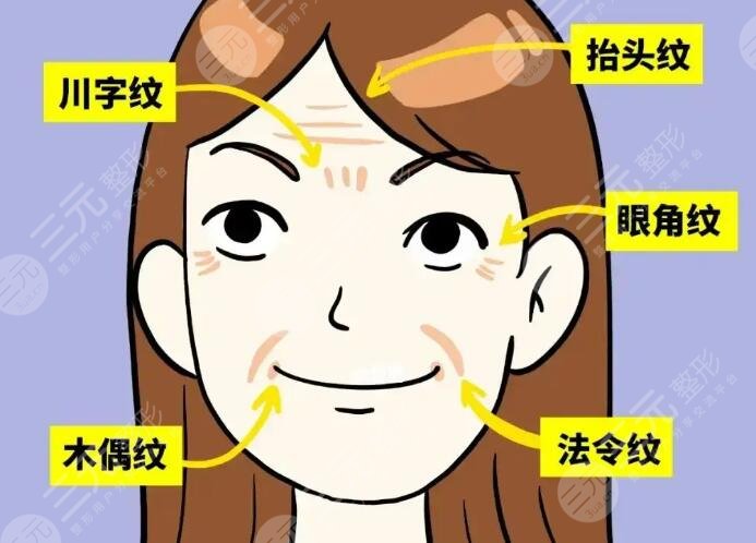 表情紋