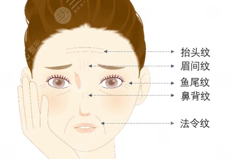 表情紋