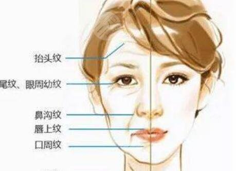 表情紋