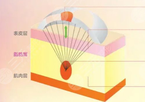 電波拉皮效果好嗎能維持多久？