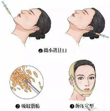 臉部吸脂肪大概需要多少錢？價格表公開！3家正規(guī)醫(yī)院介紹~