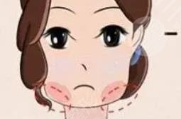 下頜角磨骨