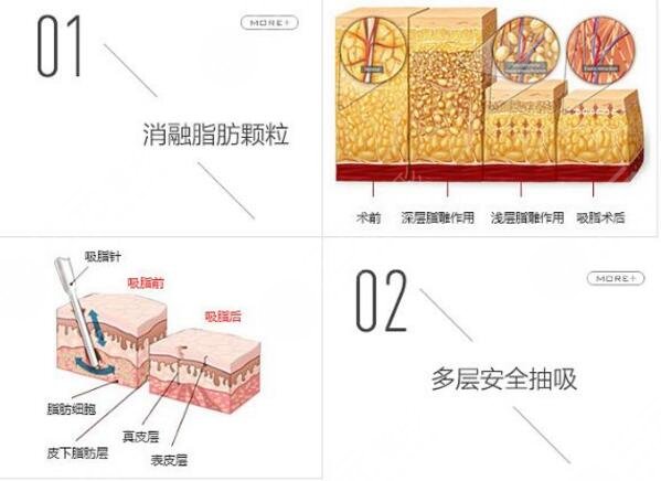 男人胸部吸脂多少錢？手術(shù)費用價格表分享！術(shù)前必看指南~