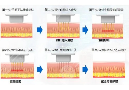 美迪邁黃金微針和半島區(qū)別