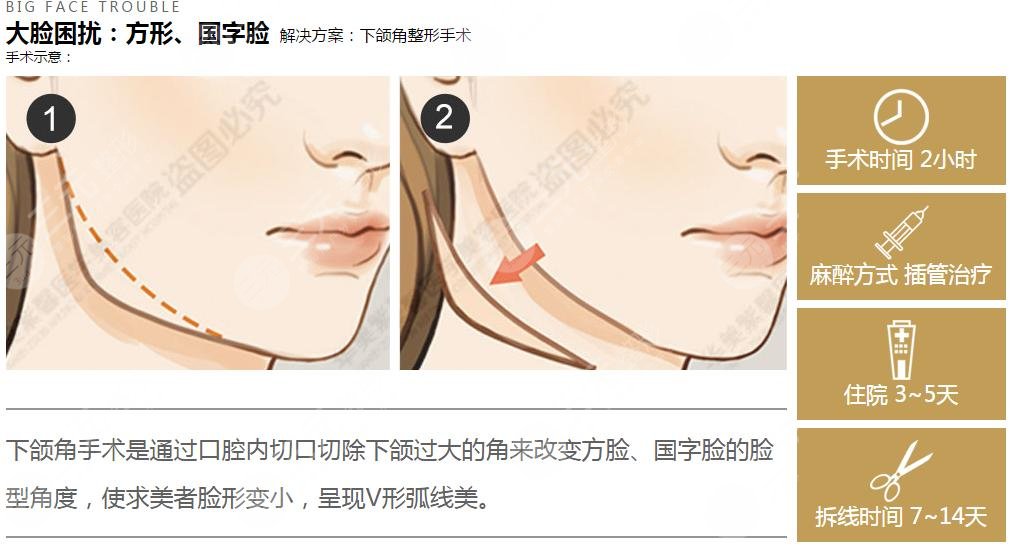 上海愉悅薇萊(原美聯(lián)臣)做下頜角怎么樣？
