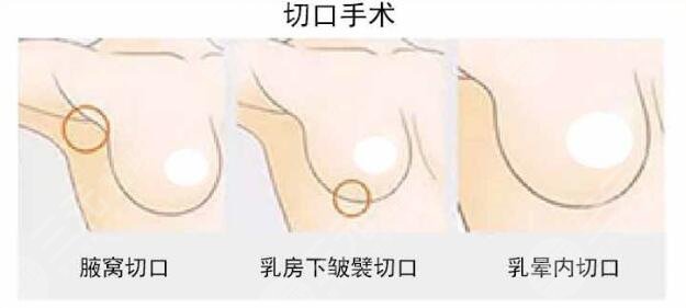 假體豐胸腋下切口多久能長好?