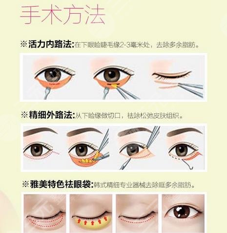 手術去眼袋