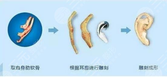 外耳再造手術(shù)需要多少費(fèi)用？?jī)r(jià)格表大全，匯總分享！