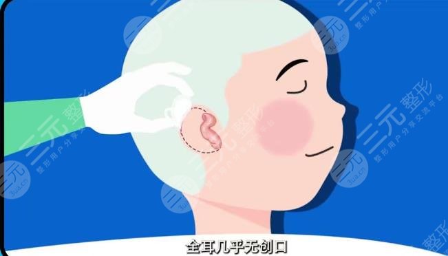 耳再造