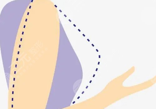 林沸騰醫(yī)生內(nèi)窺鏡隆胸怎么樣？