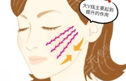 埋線提升