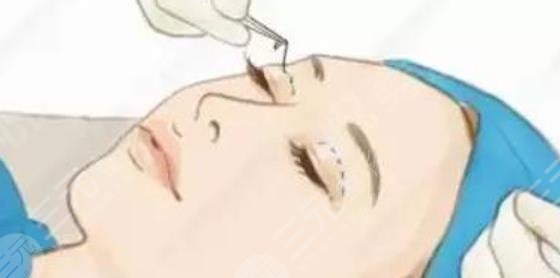 雙眼皮