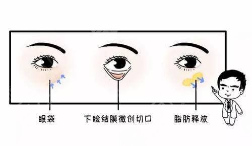 重慶美萊做眼袋手術(shù)