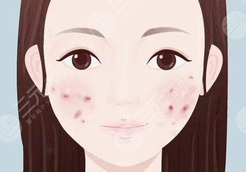 痘印怎么消除？