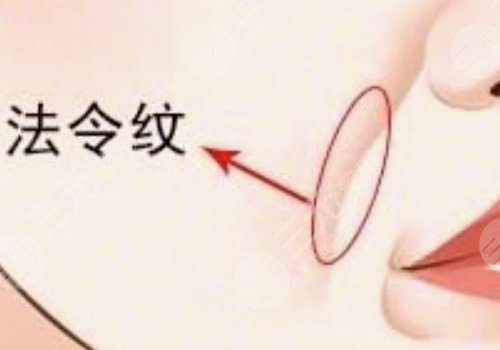 法令紋太深了有什么解決辦法？