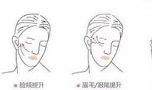 面部提升