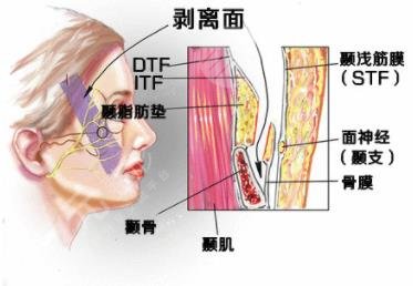 面部提升術
