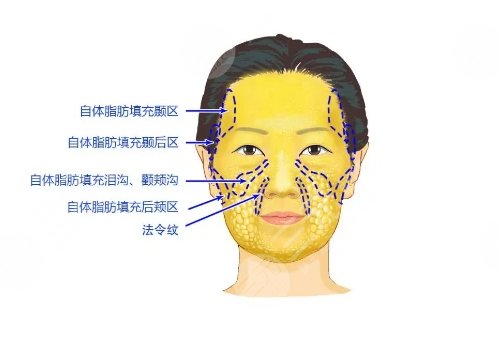法令紋怎么才能去掉