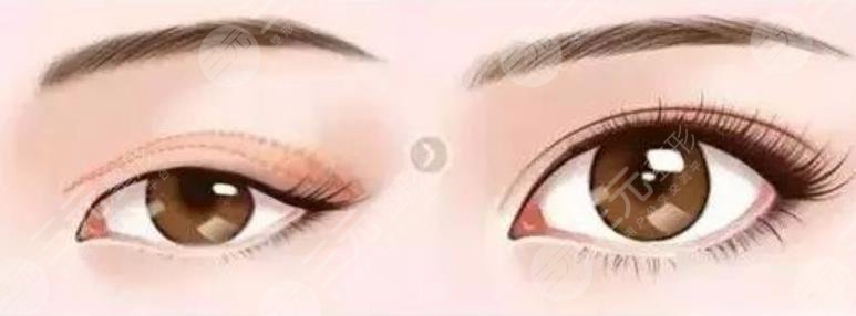 雙眼皮