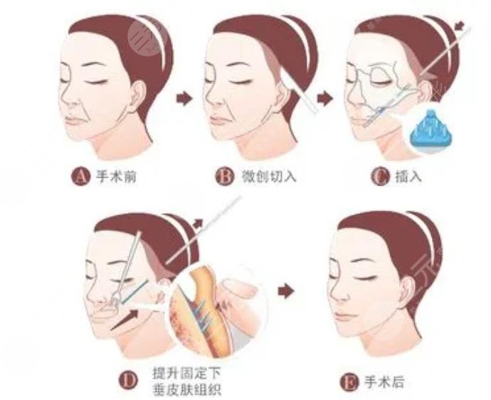 雙矢量提升術多大歲數(shù)能做