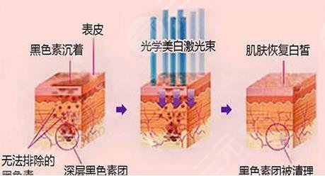 曬黑后快速美白的方法有哪些?