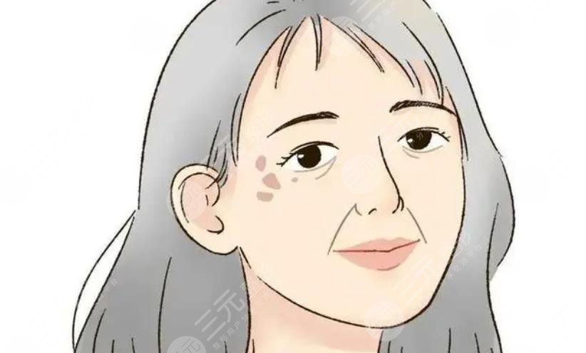 老年斑是怎么形成的?形成原因