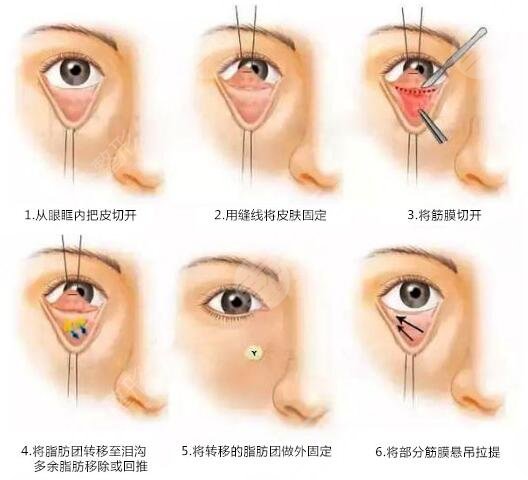 眼袋要怎么消除才有效?