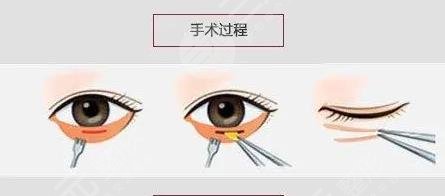 眼袋要怎么消除才有效?