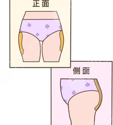 臀部?jī)蓚?cè)凸起怎么整形？吸脂體雕助你矯正不美臀型！