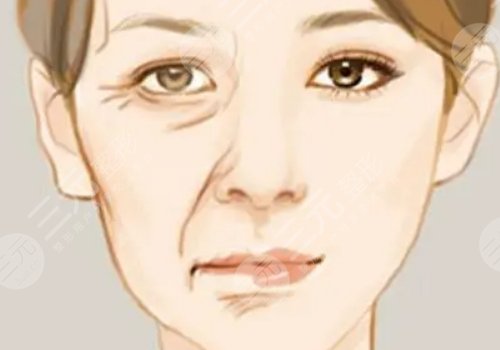 括號紋怎么去掉？怎么形成的？改良方式解讀！